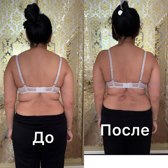 Баночный массаж, спина: фото до и после сеанса