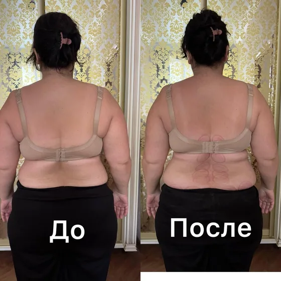 Баночный массаж, поясница: фото до и после сеанса