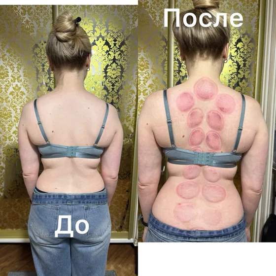 Баночный массаж, спина: фото до и после сеанса