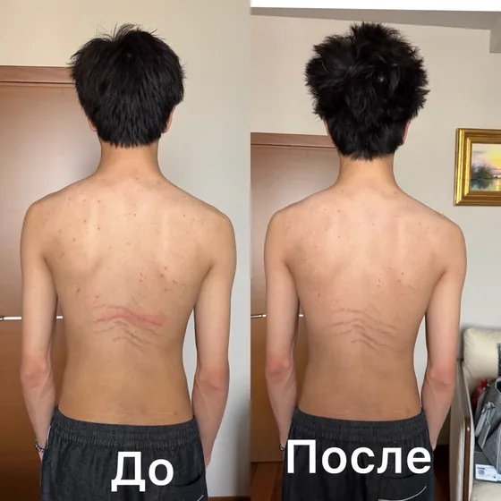 Осанка у подростка, спина: фото до и после первого сеанса